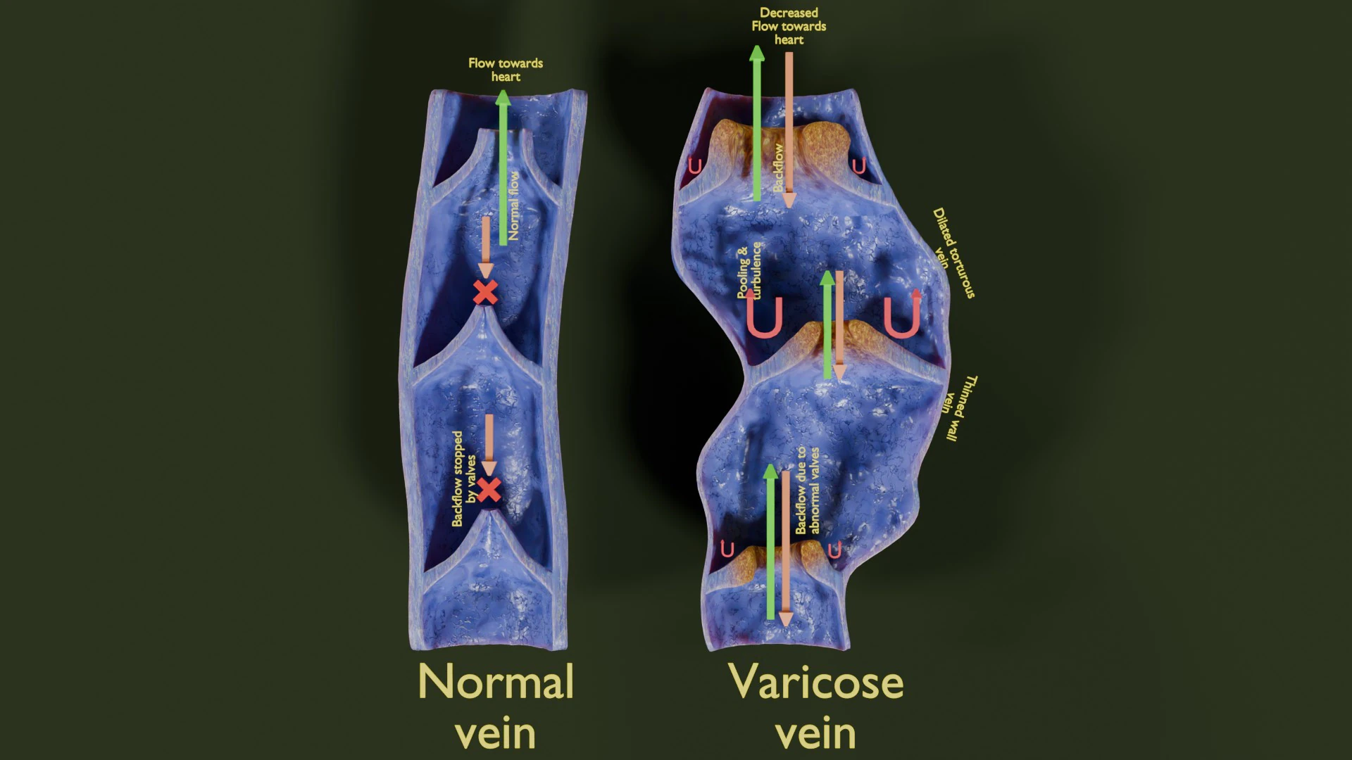 Varicose vein valve 3D Model .c4d .max .obj .3ds .fbx .stl .blend 