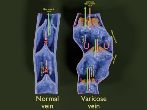 Krampfaderklappe 3D Modell