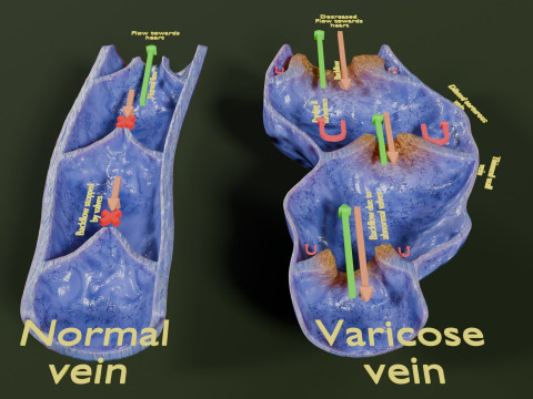 Krampfaderklappe 3D Modell