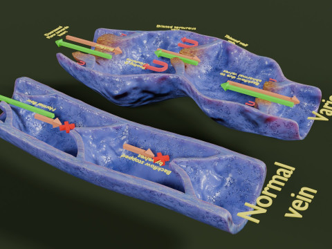 Krampfaderklappe 3D Modell