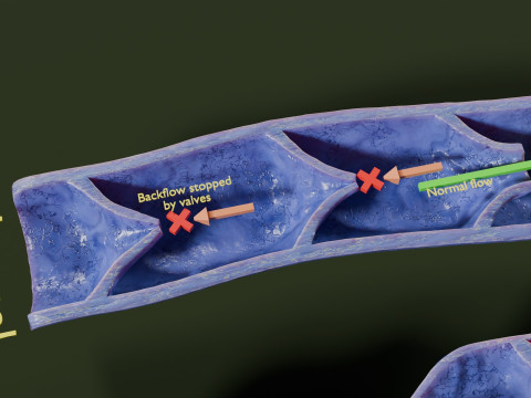 Krampfaderklappe 3D Modell