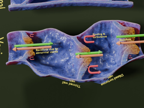 Krampfaderklappe 3D Modell
