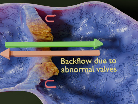 Krampfaderklappe 3D Modell