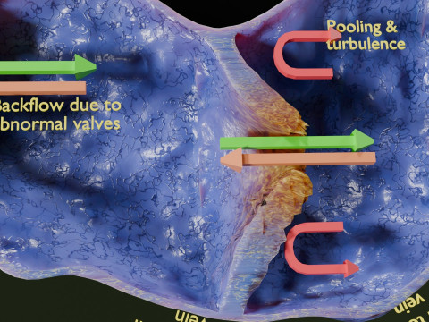 Krampfaderklappe 3D Modell