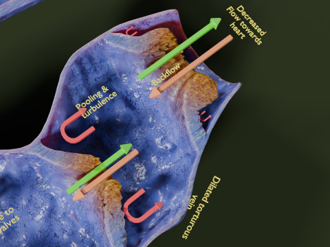 Krampfaderklappe 3D Modell