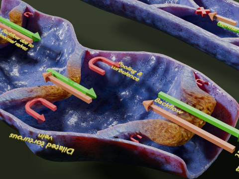 Krampfaderklappe 3D Modell