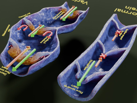 Krampfaderklappe 3D Modell