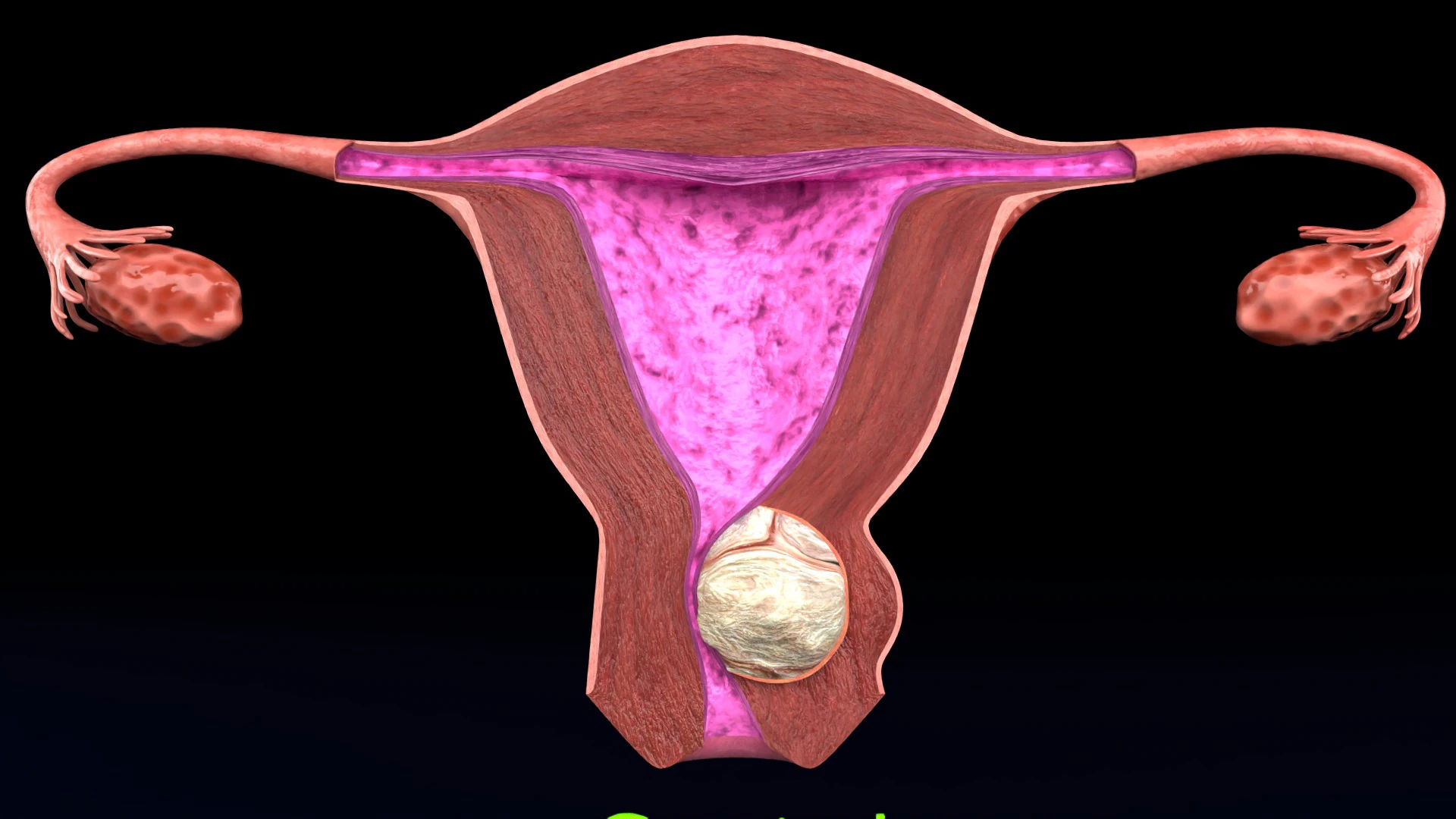 Uterus normal versus fibroid types 3d set 3D Model .c4d .max .obj .3ds .fbx .stl .blend