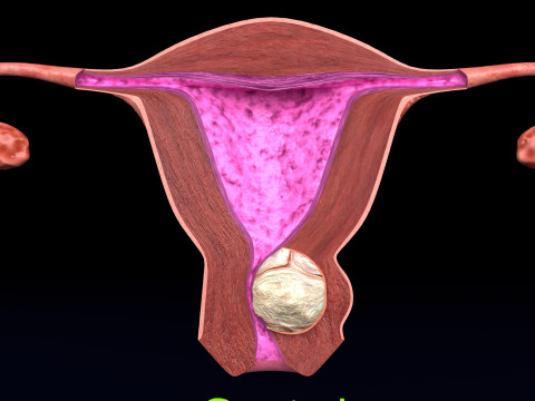 Utero normale rispetto ai tipi di fibromi set 3d Modello 3D