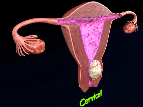 Uterus normal versus fibroid types 3d set 3D Model
