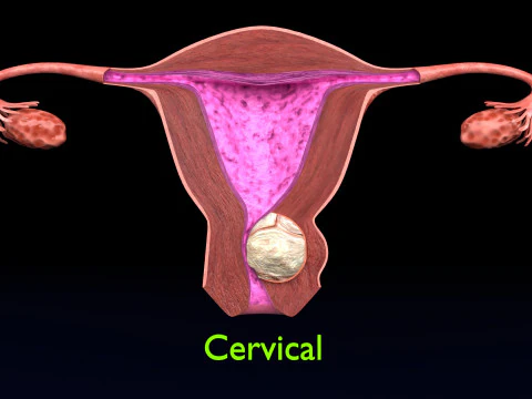 Uterus normal versus fibroid types 3d set 3D Model