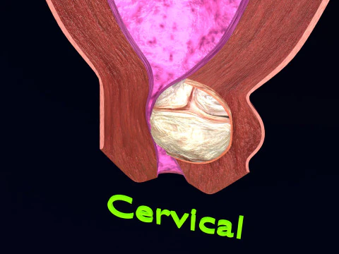 Uterus normal versus fibroid types 3d set 3D Model