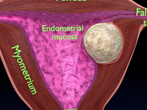 Uterus normal versus fibroid types 3d set 3D Model