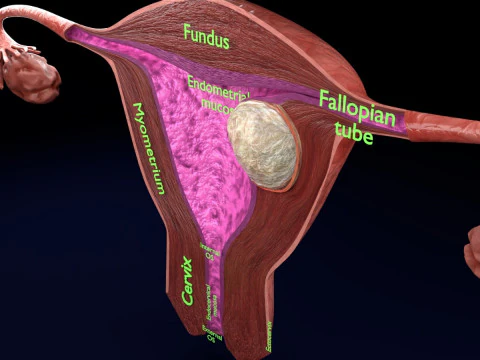 Uterus normal versus fibroid types 3d set 3D Model