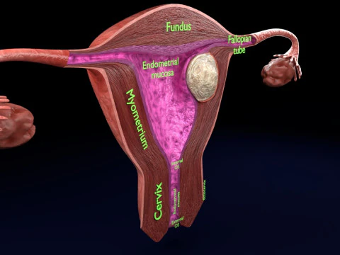 Uterus normal versus fibroid types 3d set 3D Model