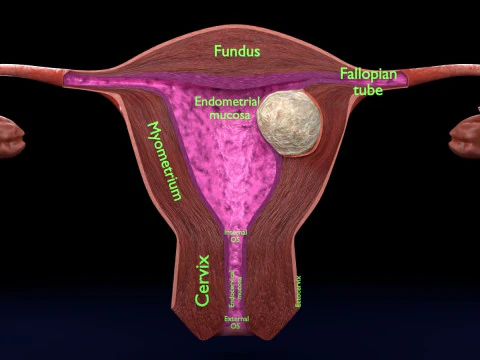 Uterus normal versus fibroid types 3d set 3D Model