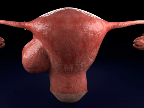 Uterus normal versus fibroid types 3d set 3D Model
