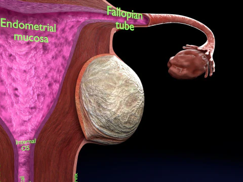 Uterus normal versus fibroid types 3d set 3D Model