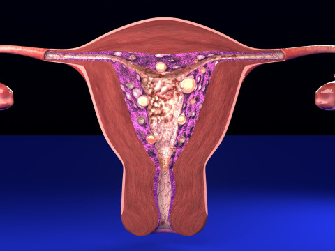 Uterus endometrial lesions model set - hyperplasia polyp cyst cancer model set 3D Model
