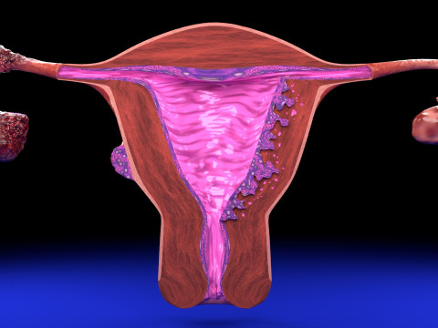 Uterus adenomyosis versus endometriosis 3D Model