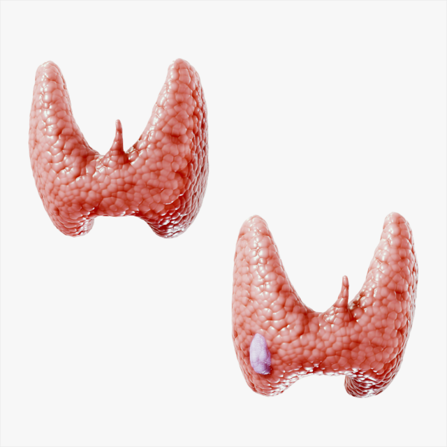 Healthy Thyroid and Thyroid Cancer 3D Model .c4d .max .obj .3ds .fbx .stl .blend 