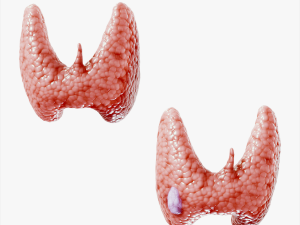 Healthy Thyroid and Thyroid Cancer Model 3D