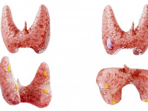Healthy Thyroid and Thyroid Cancer 3D Model