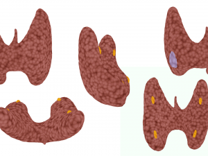 Healthy Thyroid and Thyroid Cancer 3D Model