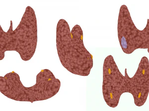 Healthy Thyroid and Thyroid Cancer 3D Model