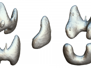 Healthy Thyroid and Thyroid Cancer 3D Model