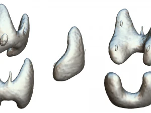 Healthy Thyroid and Thyroid Cancer 3D Model