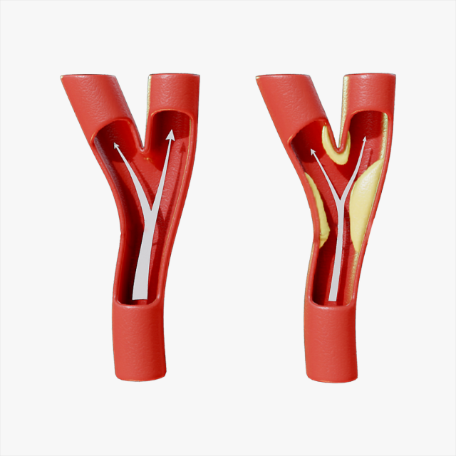 Peripheral Artery Disease 3Dモデル .c4d .max .obj .3ds .fbx .stl .blend 