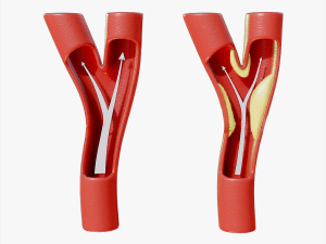 Peripheral Artery Disease 3Dモデル