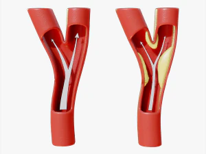 周围动脉疾病 3D 模型