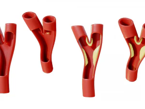 周围动脉疾病 3D 模型