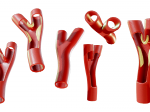 Peripheral Artery Disease 3Dモデル
