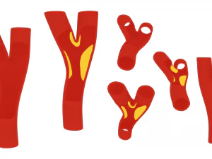 周围动脉疾病 3D 模型