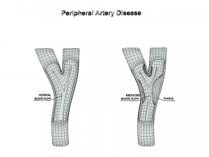 Peripheral Artery Disease 3Dモデル