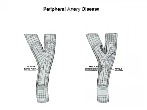 周围动脉疾病 3D 模型