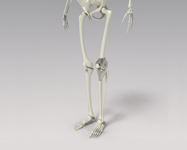 Knee Tumor Prosthesis Modelo 3D .c4d .max .obj .3ds .fbx .stl .blend 