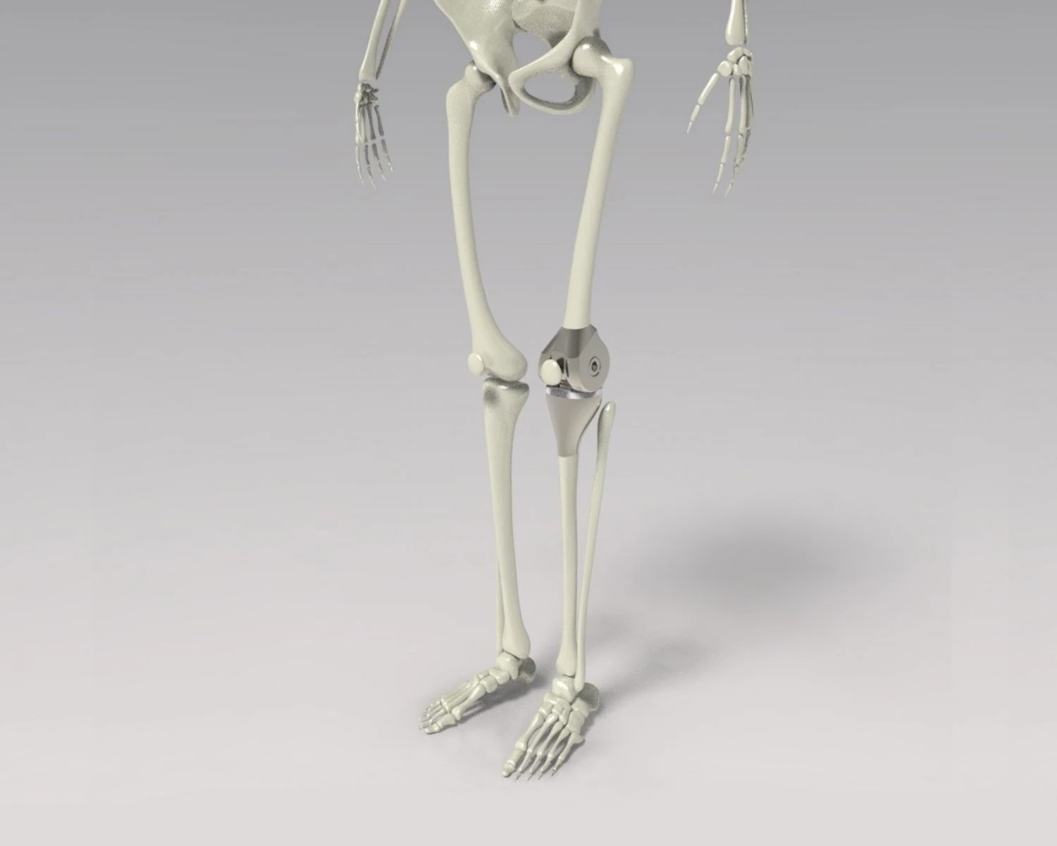 Knee Tumor Prosthesis 3D Model .c4d .max .obj .3ds .fbx .stl .blend 