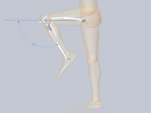 Knee Tumor Prosthesis Modelo 3D