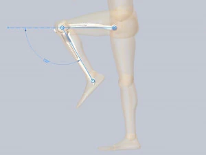 Knee Tumor Prosthesis 3D Model