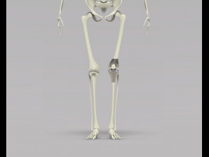 Knee Tumor Prosthesis Modelo 3D