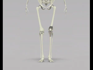 Knee Tumor Prosthesis 3D Model