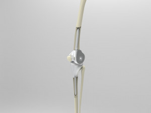 Knee Tumor Prosthesis Modelo 3D