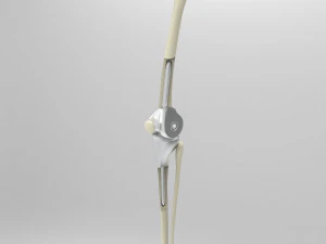 Knee Tumor Prosthesis 3D Model