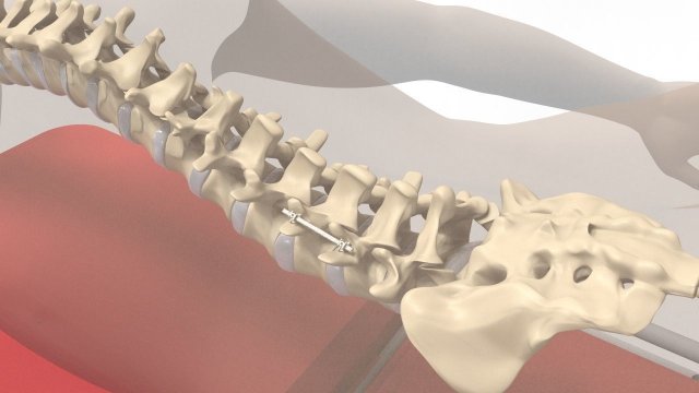 Human Spine and Implant Modèle 3D .c4d .max .obj .3ds .fbx .stl .blend 
