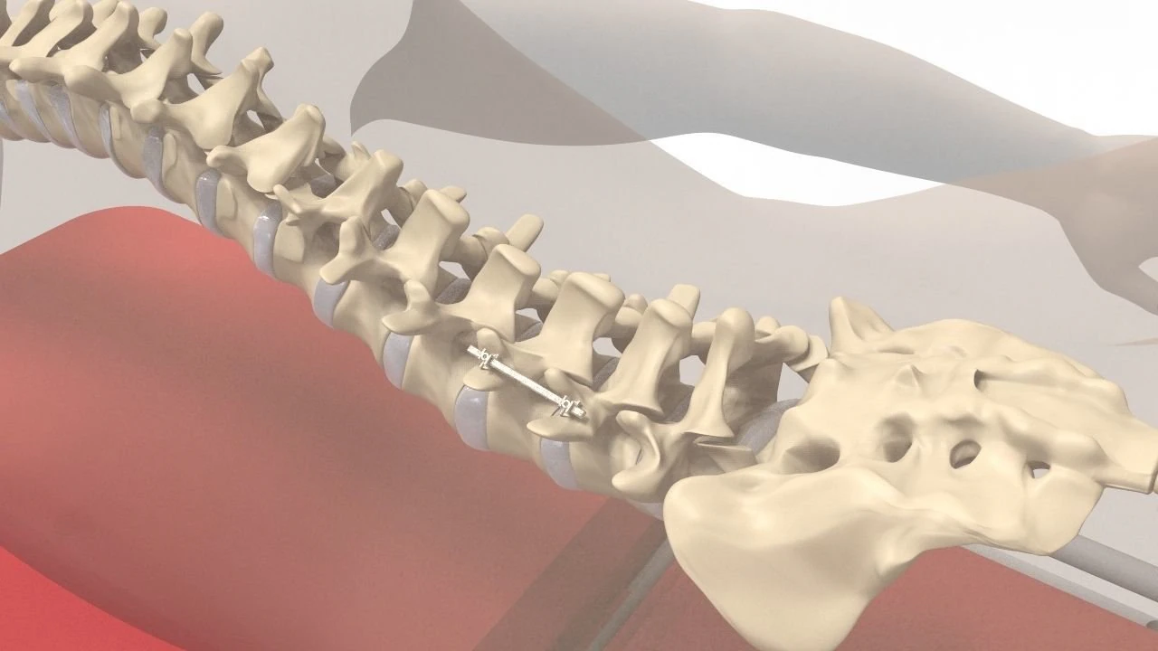 Human Spine and Implant 3D Model .c4d .max .obj .3ds .fbx .stl .blend