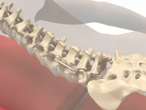 Ludzki kręgosłup i implant Model 3D